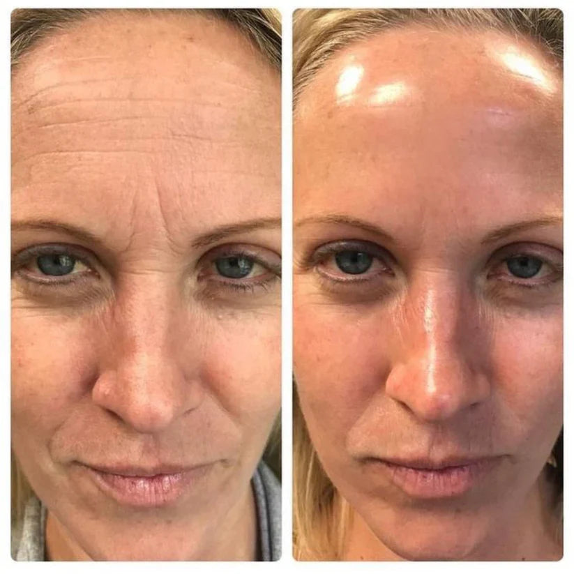 Fiorea® Retinal Shot - Adiós Arrugas y Lineas de Expresion