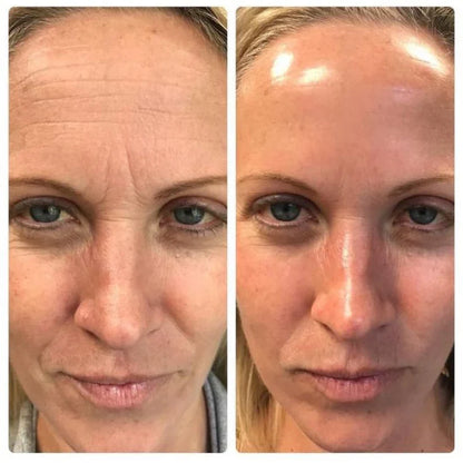 Fiorea® Retinal Shot - Adiós Arrugas y Lineas de Expresion